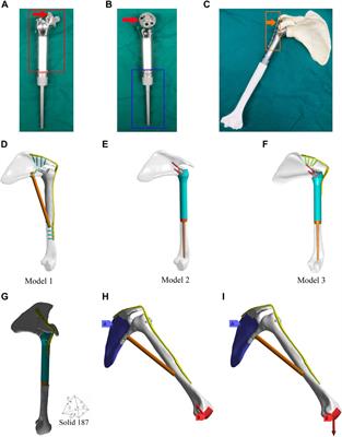 Design and validation of a novel 3D-printed glenohumeral fusion prosthesis for the reconstruction of proximal humerus bone defects: a biomechanical study
